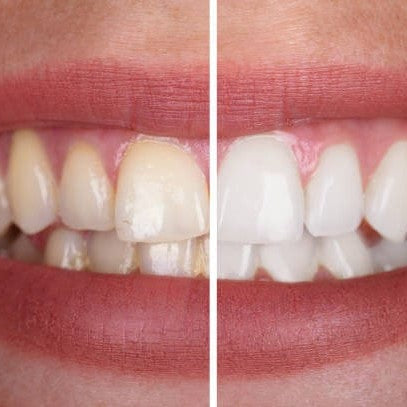 Brillaglo™ — Gel blanchissant pour un sourire rayonnant et confiant